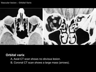 Vascular lesion  >  Orbital Varix Orbital varix A, Axial CT scan shows no obvious lesion.  B, Coronal CT scan shows a large mass (arrows). 