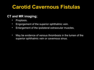 Carotid Cavernous Fistulas  CT and MR imaging; Proptosis. Engorgement of the superior ophthalmic vein. Enlargement of the ipsilateral extraocular muscles.  May be evidence of venous thrombosis in the lumen of the superior ophthalmic vein or cavernous sinus.  