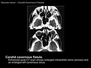 Vascular lesion  >  Carotid Cavernous Fistulas  Carotid cavernous fistula.  Enhanced axial CT scan shows enlarged intraorbital veins (arrows) and an enlarged left cavernous sinus. 