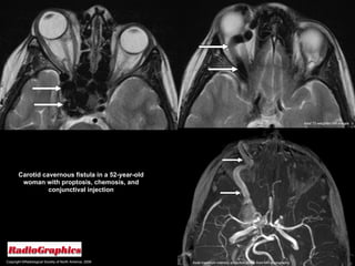 Copyright ©Radiological Society of North America, 2008 Carotid cavernous fistula in a 52-year-old woman with proptosis, chemosis, and conjunctival injection Axial T2-weighted MR images Axial maximum intensity projection image from MR angiography 