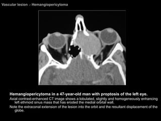 Vascular lesion  >  Hemangiopericytoma Hemangiopericytoma in a 47-year-old man with proptosis of the left eye.  Axial contrast-enhanced CT image shows a lobulated, slightly and homogeneously enhancing left ethmoid sinus mass that has eroded the medial orbital wall.  Note the extraconal extension of the lesion into the orbit and the resultant displacement of the globe. 