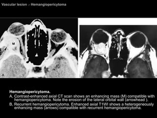 Vascular lesion  >  Hemangiopericytoma Hemangiopericytoma.  A, Contrast-enhanced axial CT scan shows an enhancing mass (M) compatible with hemangiopericytoma. Note the erosion of the lateral orbital wall (arrowhead ).  B, Recurrent hemangiopericytoma. Enhanced axial T1WI shows a heterogeneously enhancing mass (arrows) compatible with recurrent hemangiopericytoma. 