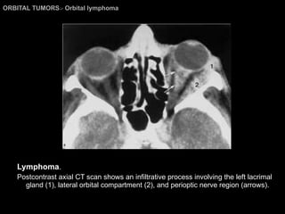 ORBITAL TUMORS >  Orbital lymphoma Lymphoma . Postcontrast axial CT scan shows an infiltrative process involving the left lacrimal gland (1), lateral orbital compartment (2), and perioptic nerve region (arrows). 