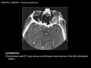 ORBITAL TUMORS >  Orbital lymphoma Lymphoma . Postcontrast axial CT scan shows a soft-tissue mass (arrow) in the left retrobulbar region. 