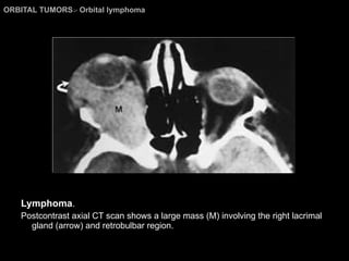ORBITAL TUMORS >  Orbital lymphoma Lymphoma . Postcontrast axial CT scan shows a large mass (M) involving the right lacrimal gland (arrow) and retrobulbar region. 