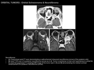 ORBITAL TUMORS >  Orbital Schwannoma & Neurofibroma Neurofibroma A , Postcontrast axial CT scan demonstrating a well-enhanced intraconal neurofibroma ( arrow ) of the posterior orbit.  B , Axial T1WI scan of a posterior neurofibroma ( arrow ) as in  A . Tumor is isointense to brain and hypointense to orbital fat.  C , Axial fat-suppressed T1-weighted MR image of the tumor seen in  A  and  B  demonstrating the marked contrast enhancement of a posterior neurofibroma ( arrow ). 