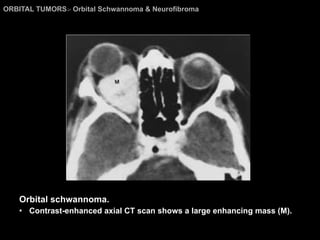 ORBITAL TUMORS >  Orbital Schwannoma & Neurofibroma Orbital schwannoma. Contrast-enhanced axial CT scan shows a large enhancing mass (M). 