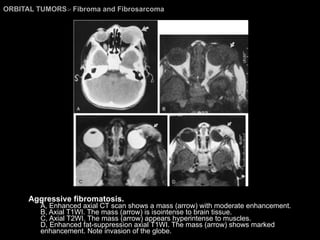 ORBITAL TUMORS >  Fibroma and Fibrosarcoma Aggressive fibromatosis.  A, Enhanced axial CT scan shows a mass (arrow) with moderate enhancement.  B, Axial T1WI. The mass (arrow) is isointense to brain tissue.  C, Axial T2WI. The mass (arrow) appears hyperintense to muscles.  D, Enhanced fat-suppression axial T1WI. The mass (arrow) shows marked enhancement. Note invasion of the globe. 