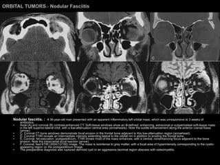 ORBITAL TUMORS >  Nodular Fasciitis Nodular fasciitis. :  A 36-year-old man presented with an apparent inflammatory left orbital mass, which was unresponsive to 3 weeks of antibiotics.  Axial (A) and coronal (B) contrast-enhanced CT: Soft-tissue windows show an ill-defined, enhancing, extraconal or subperiosteal soft-tissue mass in the left superior-lateral orbit, with a low-attenuation central area (arrowheads). Note the subtle enhancement along the anterior cranial fossa (arrow).  C, Coronal CT bone windows demonstrate focal erosion in the frontal bone adjacent to this low-attenuation region (arrowhead).  D, Coronal T1WI reveals an intermediate intensity extending lateral to the orbital rim in addition to eroding the frontal bone.  E, Coronal, fat-saturation, postgadolinium, T1WI shows most of the mass enhances, with a central, nonenhancing focus adjacent to the bone erosion. Note the intracranial dural reaction (arrow).  F, Coronal, fast-STIR (2000/12/160) image. The mass is isointense to gray matter, with a focal area of hyperintensity corresponding to the cystic-appearing region on the postgadolinium image.  The preoperative diagnosis was ruptured dermoid cyst or an aggressive lacrimal region abscess with osteomyelitis.  