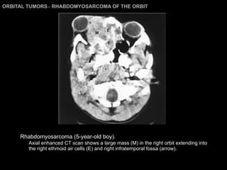 ORBITAL TUMORS >  RHABDOMYOSARCOMA OF THE ORBIT Rhabdomyosarcoma (5-year-old boy).   Axial enhanced CT scan shows a large mass (M) in the right orbit extending into the right ethmoid air cells (E) and right infratemporal fossa (arrow). 