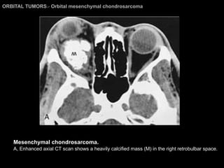 ORBITAL TUMORS >  Orbital mesenchymal chondrosarcoma Mesenchymal chondrosarcoma.  A, Enhanced axial CT scan shows a heavily calcified mass (M) in the right retrobulbar space.  