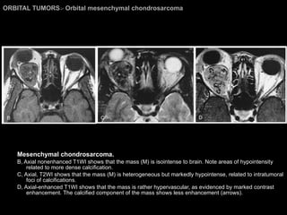 ORBITAL TUMORS >  Orbital mesenchymal chondrosarcoma Mesenchymal chondrosarcoma.  B, Axial nonenhanced T1WI shows that the mass (M) is isointense to brain. Note areas of hypointensity related to more dense calcification.  C, Axial, T2WI shows that the mass (M) is heterogeneous but markedly hypointense, related to intratumoral foci of calcifications.  D, Axial-enhanced T1WI shows that the mass is rather hypervascular, as evidenced by marked contrast enhancement. The calcified component of the mass shows less enhancement (arrows).  