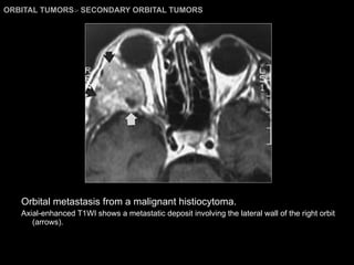 ORBITAL TUMORS >  SECONDARY ORBITAL TUMORS Orbital metastasis from a malignant histiocytoma. Axial-enhanced T1WI shows a metastatic deposit involving the lateral wall of the right orbit (arrows). 