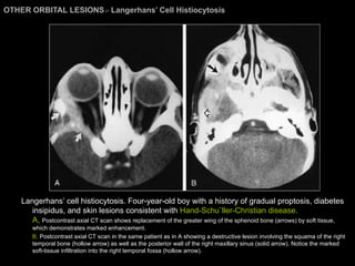 OTHER ORBITAL LESIONS >  Langerhans’ Cell Histiocytosis  Langerhans’ cell histiocytosis. Four-year-old boy with a history of gradual proptosis, diabetes insipidus, and skin lesions consistent with  Hand-Schu¨ller-Christian disease.  A,  Postcontrast axial CT scan shows replacement of the greater wing of the sphenoid bone (arrows) by soft tissue, which demonstrates marked enhancement.  B,  Postcontrast axial CT scan in the same patient as in A showing a destructive lesion involving the squama of the right temporal bone (hollow arrow) as well as the posterior wall of the right maxillary sinus (solid arrow). Notice the marked soft-tissue infiltration into the right temporal fossa (hollow arrow). 