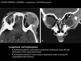 OTHER ORBITAL LESIONS >  Langerhans’ Cell Histiocytosis  Langerhans’ cell histiocytosis.  A, Enhanced axial CT scan shows a prominent soft-tissue mass (M) with destruction of the orbital wall (arrow).  B, Enhanced coronal CT scan shows a destructive mass involving the superolateral orbit (arrows). 