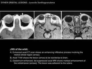 OTHER ORBITAL LESIONS >  Juvenile Xanthogranuloma JXG of the orbit.  A, Enhanced axial CT scan shows an enhancing infiltrative process involving the medial orbital region (arrow).  B, Axial T1WI shows the lesion (arrow) to be isointense to brain.  C, Gadolinium-enhanced, fat-suppressed axial MRI shows marked enhancement of the orbital lesion (arrows). The lesion was adherent to the sclera. 
