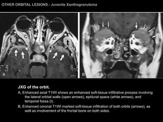OTHER ORBITAL LESIONS >  Juvenile Xanthogranuloma JXG of the orbit.  A, Enhanced axial T1WI shows an enhanced soft-tissue infiltrative process involving the lateral orbital walls (open arrows), epidural space (white arrows), and temporal fossa (t).  B, Enhanced coronal T1WI marked soft-tissue infiltration of both orbits (arrows), as well as involvement of the frontal bone on both sides. 