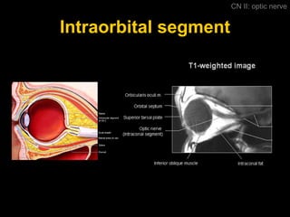 Intraorbital segment CN II: optic nerve 