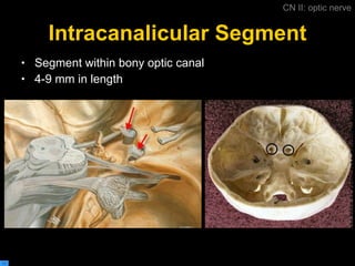Intracanalicular Segment Segment within bony optic canal  4-9 mm in length CN II: optic nerve 
