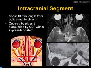 Intracranial Segment About 10 mm length from optic canal to chiasm Covered by pia and surrounded by CSF within suprasellar cistern CN II: optic nerve 