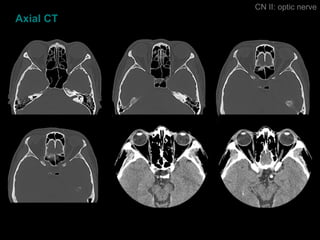 Axial CT CN II: optic nerve 