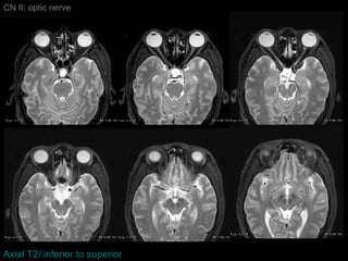 CN II: optic nerve Axial T2/ inferior to superior 