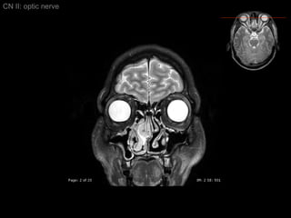 CN II: optic nerve 