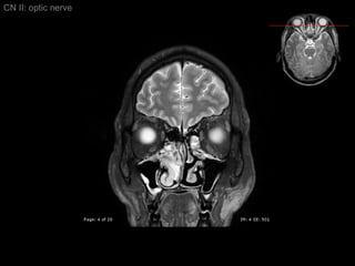 CN II: optic nerve 