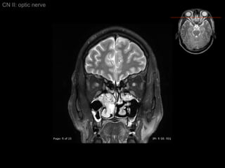 CN II: optic nerve 