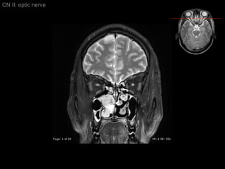 CN II: optic nerve 