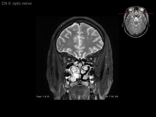 CN II: optic nerve 