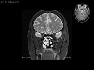 CN II: optic nerve 