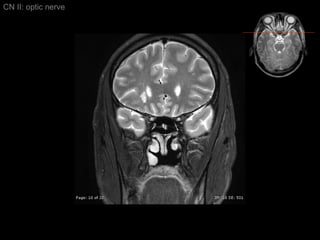 CN II: optic nerve 