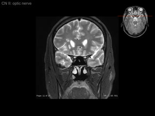 CN II: optic nerve 