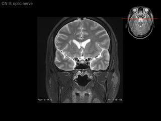 CN II: optic nerve 