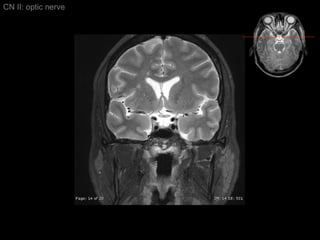 CN II: optic nerve 
