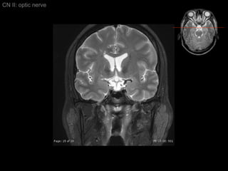 CN II: optic nerve 