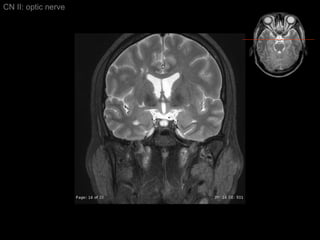 CN II: optic nerve 