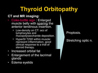 Thyroid Orbitopathy CT and MR imaging: Coke-bottle sign  : Enlarged muscle belly with  sparing  the anterior tendinous insertion.  Low-density on CT: acc of lymphocytes and mucopolysaccharide deposition. HyperSI T2WI within muscle: represent inflammation, good clinical response to a trial of steroid therapy. Increased orbital fat Enlargement of the lacrimal glands Edema eyelids Proptosis. Stretching optic n. 