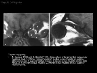 Thyroid Orbitopathy Thyroid myopathy.  A , Coronal T1WI and  B , Sagittal T1WI. Scans show enlargement of extraocular muscles. In  A ,  1 , Inferior rectus muscle;  2 , medial rectus muscle;  3 , superior oblique muscle;  4 , superior rectus muscle;  5 , lateral rectus muscle; and  6 , optic nerve.  2 ,  1 , inferior oblique muscle;  2 , inferior rectus muscle; and  3 , superior rectus muscle. 