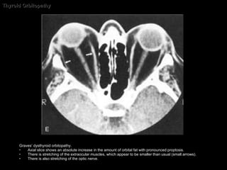 Thyroid Orbitopathy Graves’ dysthyroid orbitopathy.  Axial slice shows an absolute increase in the amount of orbital fat with pronounced proptosis.  There is stretching of the extraocular muscles, which appear to be smaller than usual (small arrows).  There is also stretching of the optic nerve. 