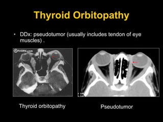Thyroid Orbitopathy DDx: pseudotumor (usually includes tendon of eye muscles) . Thyroid orbitopathy Pseudotumor 