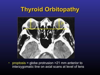 Thyroid Orbitopathy proptosis  = globe protrusion >21 mm anterior to interzygomatic line on axial scans at level of lens 21 