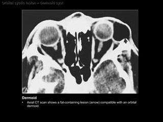 Orbital cystic lesion > Dermoid cyst Dermoid Axial CT scan shows a fat-containing lesion (arrow) compatible with an orbital dermoid. 