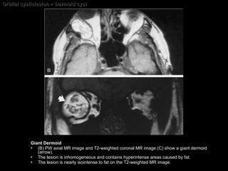 Orbital cysticlesion > Dermoid cyst Giant Dermoid (B) PW axial MR image and T2-weighted coronal MR image (C) show a giant dermoid (arrow).  The lesion is inhomogeneous and contains hyperintense areas caused by fat.  The lesion is nearly isointense to fat on the T2-weighted MR image. 