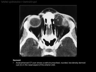 Orbital cysticlesion > Dermoid cyst Dermoid Axial-enhanced CT scan shows a well-circumscribed, rounded, low-density dermoid cyst (C) in the nasal aspect of the anterior orbit. 