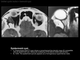 Orbital cystic lesion > Dermoid cyst Epidermoid cyst.  A, Postcontrast axial CT scan shows a nonenhanced low-density mass (E) compatible with an epidermoid cyst. Notice the scalloping of the lateral orbital wall (arrows).  B, T2WI. The epidermoid cyst (E) appears as a homogeneous hyperintense mass. 