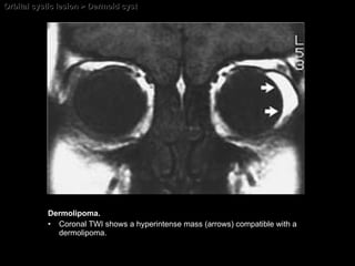 Orbital cystic lesion > Dermoid cyst Dermolipoma. Coronal TWI shows a hyperintense mass (arrows) compatible with a dermolipoma. 