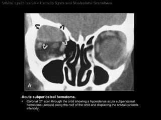 Orbital cystic lesion > Hematic Cysts and Cholesterol Granuloma Acute subperiosteal hematoma. Coronal CT scan through the orbit showing a hyperdense acute subperiosteal hematoma (arrows) along the roof of the orbit and displacing the orbital contents inferiorly. 