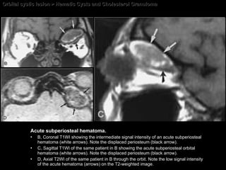 Orbital cystic lesion > Hematic Cysts and Cholesterol Granuloma Acute subperiosteal hematoma. B, Coronal T1WI showing the intermediate signal intensity of an acute subperiosteal hematoma (white arrows). Note the displaced periosteum (black arrow).  C, Sagittal T1WI of the same patient in B showing the acute subperiosteal orbital hematoma (white arrows). Note the displaced periosteum (black arrow).  D, Axial T2WI of the same patient in B through the orbit. Note the low signal intensity of the acute hematoma (arrows) on the T2-weighted image. 
